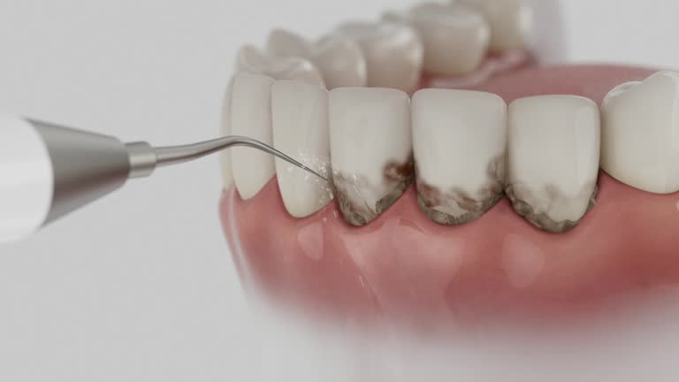 Reliable Tooth Extraction contractor in La Porte, TX by Smile Center Dentistry